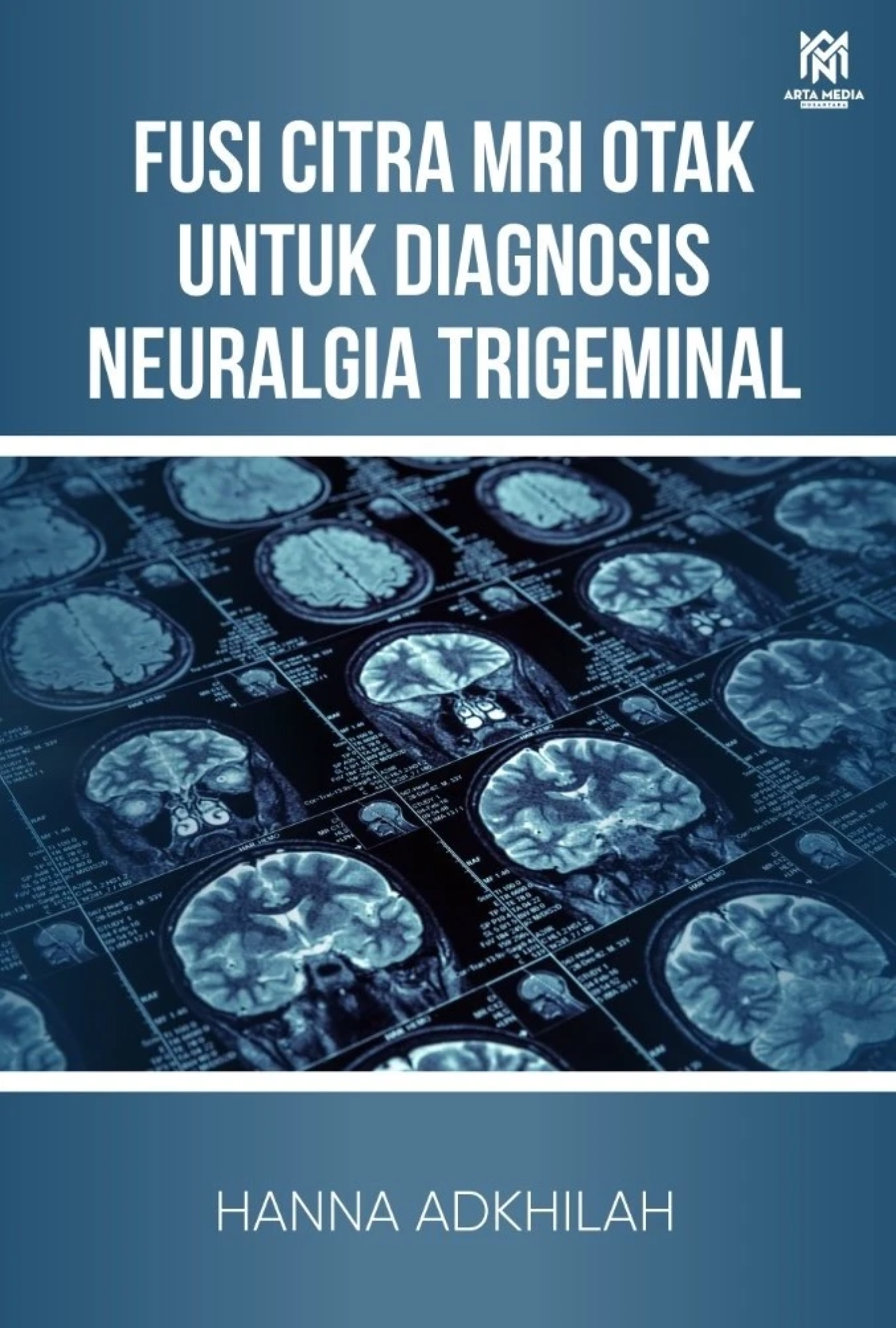 Fusi Citra MRI Otak untuk Diagnosis Neuralgia Trigeminal
